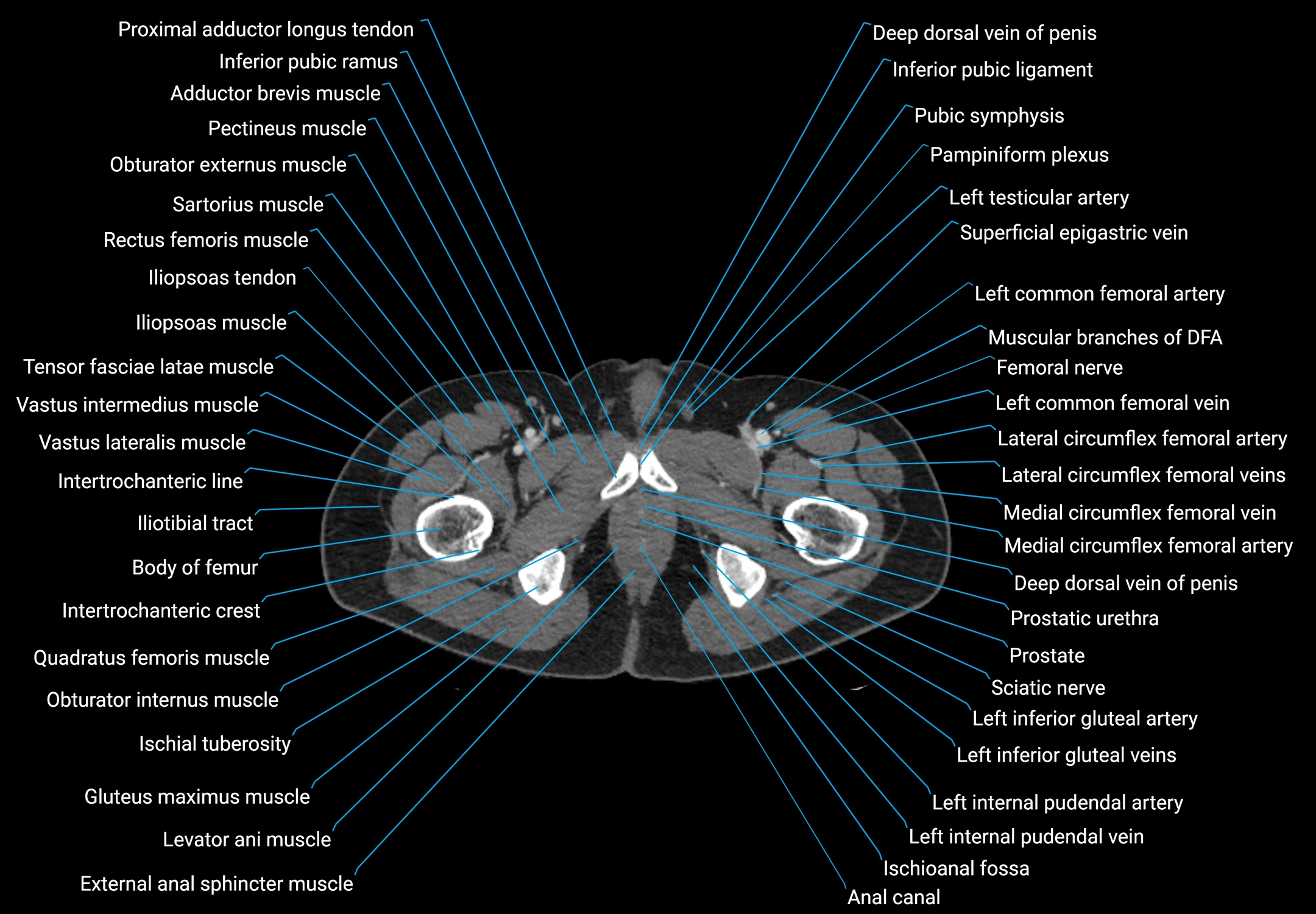 CT male pelvis axial cross sectional anatomy labelled radiology image -00207.webp
